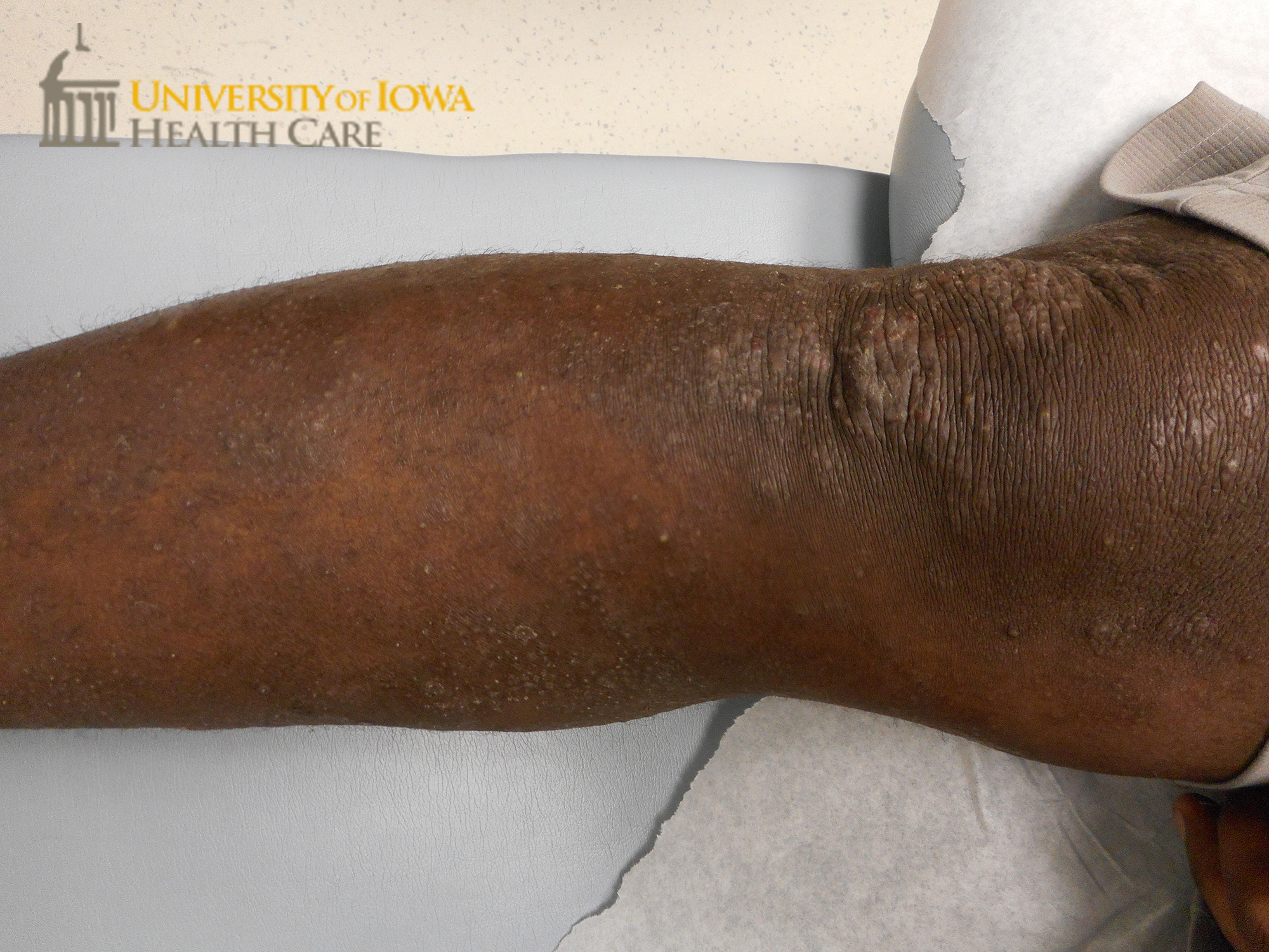 Pink waxy papules coalescing into plaques on the leg. (click images for higher resolution).